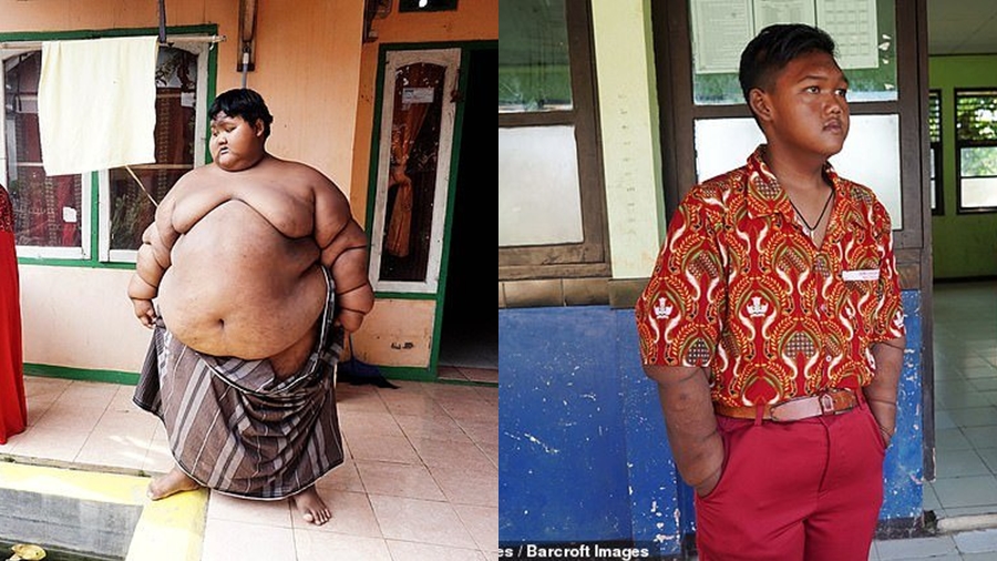Arya Permana สุขภาพ เด็กที่อ้วนที่สุดในโลก เรื่องแปลก โรคอ้วน
