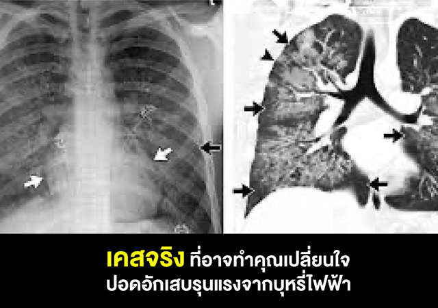 บุหรี่ไฟฟ้า ปอดแตก สูบพอด